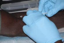 صورة منظمة الصحة العالمية تدعوا لاستخدام لقاح جديد ضد الملاريا